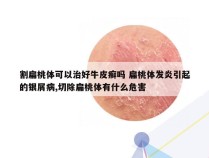 割扁桃体可以治好牛皮癣吗 扁桃体发炎引起的银屑病,切除扁桃体有什么危害
