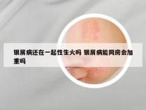 银屑病还在一起性生火吗 银屑病能同房会加重吗