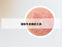 清除牛皮癣的工具
