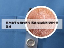 惠州治牛皮癣的医院 惠州皮肤病医院哪个医生好