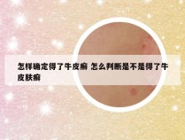 怎样确定得了牛皮癣 怎么判断是不是得了牛皮肤癣
