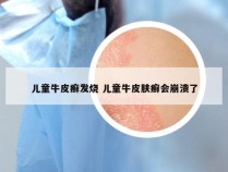 儿童牛皮癣发烧 儿童牛皮肤癣会崩溃了