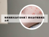 银屑病黑光治疗没效果了 黑光治疗银屑病怎么样