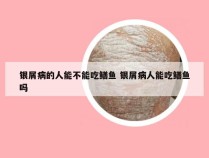 银屑病的人能不能吃鳝鱼 银屑病人能吃鳝鱼吗