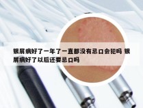 银屑病好了一年了一直都没有忌口会犯吗 银屑病好了以后还要忌口吗