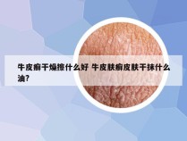 牛皮癣干燥擦什么好 牛皮肤癣皮肤干抹什么油?