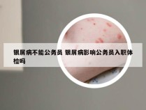 银屑病不能公务员 银屑病影响公务员入职体检吗