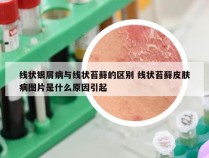 线状银屑病与线状苔藓的区别 线状苔藓皮肤病图片是什么原因引起