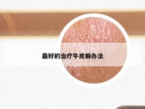 最好的治疗牛皮癣办法