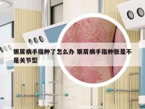 银屑病手指肿了怎么办 银屑病手指肿胀是不是关节型