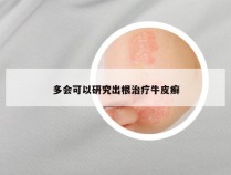 多会可以研究出根治疗牛皮癣