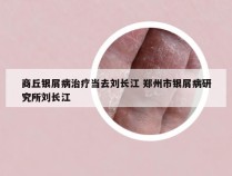 商丘银屑病治疗当去刘长江 郑州市银屑病研究所刘长江