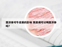 西洋参对牛皮癣的影响 银屑病可以喝西洋参吗?