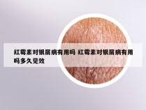 红霉素对银屑病有用吗 红霉素对银屑病有用吗多久见效
