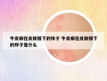 牛皮癣在皮肤镜下的样子 牛皮癣在皮肤镜下的样子是什么