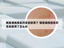 银屑病用激素药膏皮肤薄了 银屑病用激素药膏皮肤薄了怎么办