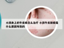小孩身上的牛皮癣怎么治疗 小孩牛皮肤癣是什么原因导致的