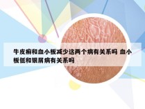 牛皮癣和血小板减少这两个病有关系吗 血小板低和银屑病有关系吗