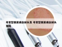 寻常型银屑病会掉头发 寻常型银屑病会掉头发吗