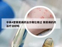 中央4套银屑病药浴方哪位用过 银屑病的药浴疗法好吗