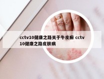 cctv10健康之路关于牛皮癣 cctv10健康之路皮肤病
