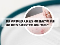 服用银屑颗粒多久就能治好银屑病了呢 服用银屑颗粒多久就能治好银屑病了呢图片