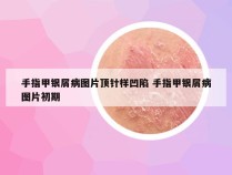 手指甲银屑病图片顶针样凹陷 手指甲银屑病图片初期