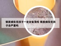 银屑病生完孩子一定会复发吗 银屑病生完孩子会严重吗