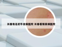 长春有名的牛皮癣医院 长春看银屑病医院