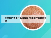 牛皮癣广告用什么清除掉 牛皮癣广告如何处理