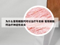 为什么葡萄糖酸钙可以治疗牛皮癣 葡萄糖酸钙治疗神经性皮炎
