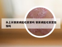 头上长银屑病能吃紫莱吗 银屑病能吃紫菜包饭吗