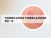 牛皮癣用什么药膏涂 牛皮癣用什么药膏涂好得快一点