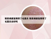 银屑病康复期得了毛囊炎 银屑病康复期得了毛囊炎会好吗