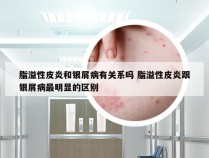 脂溢性皮炎和银屑病有关系吗 脂溢性皮炎跟银屑病最明显的区别