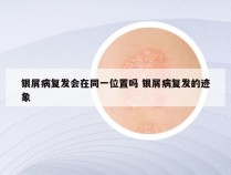 银屑病复发会在同一位置吗 银屑病复发的迹象