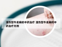 湿热型牛皮癣的中药治疗 湿热型牛皮癣的中药治疗方剂