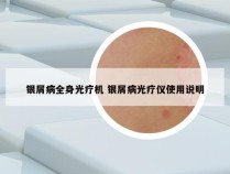 银屑病全身光疗机 银屑病光疗仪使用说明