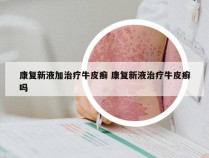 康复新液加治疗牛皮癣 康复新液治疗牛皮癣吗
