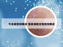 牛皮癣割双眼皮 银屑病稳定期割双眼皮