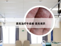 类克治疗牛皮癣 类克用药