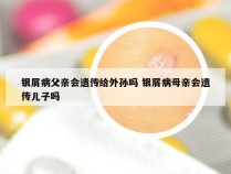 银屑病父亲会遗传给外孙吗 银屑病母亲会遗传儿子吗