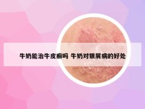 牛奶能治牛皮癣吗 牛奶对银屑病的好处
