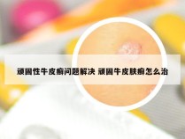 顽固性牛皮癣问题解决 顽固牛皮肤癣怎么治