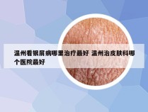 温州看银屑病哪里治疗最好 温州治皮肤科哪个医院最好