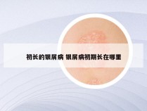 初长的银屑病 银屑病初期长在哪里