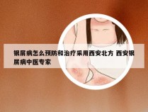 银屑病怎么预防和治疗采用西安北方 西安银屑病中医专家