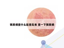 银屑病查什么能查出来 查一下银屑病