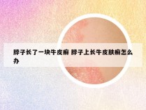 脖子长了一块牛皮癣 脖子上长牛皮肤癣怎么办