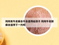 妈妈有牛皮癣会不会遗传给孩子 妈妈牛皮肤癣会遗传下一代吗